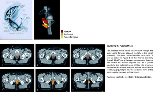 Figure 1. Countoring the pudendal nerve. The pudendal nerve enters the perinium through the lesser sciatic foramen adjacent medially to the ischial tuberosity. This point can be identified in an axial CT slice as shown in (1). It then travels anteriorly through Alcock's canal between the obturator internus and levator ani muscles (2–5). As it passes anteriorily the pudendal nerve divides into branches; the inferior rectal nerve, then the perineal nerve, before continuing (6) to become the dorsal nerve of the penis entering the deep perineal pouch. This figure was kindly provided by Dr Jonathon Hutton