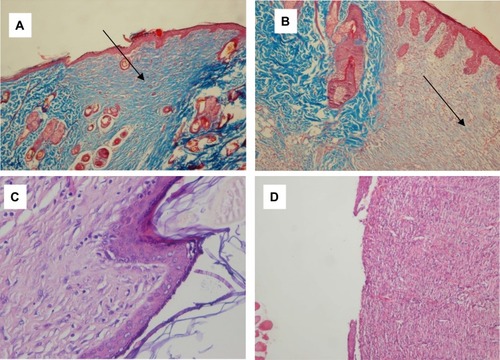 Figure 2 (A) AZL-CMC treated wound, day 12, arrow shows collagen deposition in the ulcer (score 3), Masson’s trichrome 100×. (B) Control wound, day 12, arrow shows sparse collagen deposition in the ulcer (score 1), Masson’s trichrome 100×. (C) AZL-CMC treated wound, day 12, complete epithelialization (score 3) and matured granulation tissue (score 3) H & E 400×. (D) Control wound, day 12, ulcer with partial epithelialization (score 1), H & E 100×.