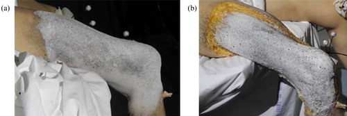 Figure 1. Speckle pattern on the right thigh: (a) skin, (b) fascia. Tripods of markers are partly visible.