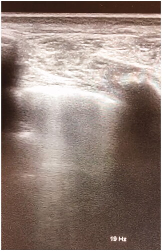 Figure 1. Bedside evaluation by a primary care physician of a patient with SARS-CoV-2 infection: B-lines at lung ultrasound appear as slightly hyperechoic bundles perpendicular to the hyperechoic pleural line.