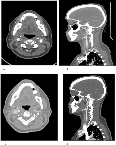 Figure 2 (A and B) computed tomography angiography of 51 years old female with ILT of ICA. (C and D) Follow-up computed tomography angiography of the same patient within 3 months shows complete resolution of the thrombus after starting medical treatments.