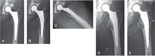 Figure 3. Example of a revision case 3 years after surgery (A), and 5 years after surgery showing extensive osteolysis (B and C). Another case at 2 years (D) and 6 years (E) with a similar appearance.