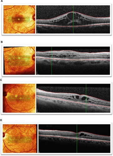 Figure 3 Spectral domain optical coherence tomographic images of three patients showing improvement in best corrected visual acuity to 20/50 or better following bevacizumab treatments for radiation maculopathy. (A) Patient 1: underwent plaque brachytherapy (right eye) with 20/25 vision at the time. Four years after treatment, the patient presented with subretinal fluid and foveal cysts, grade 6 with best corrected visual acuity of 20/80, and mean foveal thickness of 802 μm. (B) Patient 1: after treatment with six intravitreal bevacizumab treatments over 19 months, visual acuity improved to 20/25 and macular edema improved to grade 4. Mean foveal thickness decreased to 339 μm. (C) Patient 2: underwent plaque brachytherapy (left eye) with 20/400 vision at the time. Twenty-two months after treatment with plaque brachytherapy, the patient presented with grade 5 macular edema and best corrected visual acuity of 20/70 with mean foveal thickness of 483 μm. (D) Patient 2: after treatment with five intravitreal antivascular endothelial growth factor injections over 12 months, visual acuity improved to 20/25, macular edema improved to grade 4, and mean foveal thickness decreased to 366 μm. (E) Patient 3: presented with radiation maculopathy (grade 6) 31 months after treatment with plaque brachytherapy with 20/30 in the right eye and mean foveal thickness of 472 μm. (F) Patient 3: after receiving two intravitreal antivascular endothelial growth factor injections over 10 months, vision improved to 20/30, macular edema grade resolved to normal from grade 6, and mean foveal thickness decreased to 284 μm.