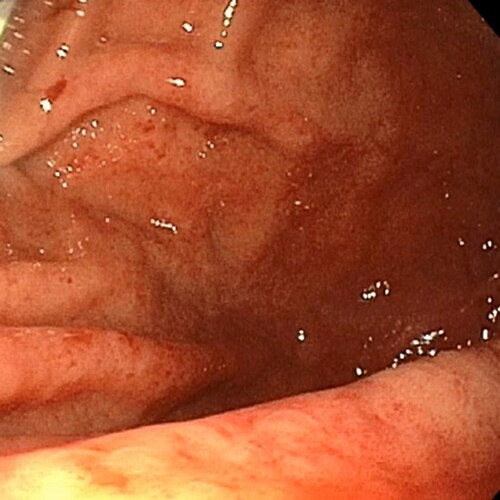 Figure 6. Endoscopy demonstrated superficial erosions, erythema, and edema of the gastric body after ingestion of ∼30ml of 35% hydrogen peroxide.