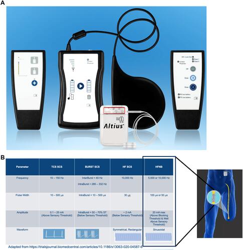 Figure 1 (A) The Altius System is designed to deliver high frequency nerve block (HFNB) pain relief therapy. Foreground: Implantable Pulse Generator (IPG) connected to a single nerve cuff electrode. Background (left to right): Physician Programming Wand, IPG Battery Charger with Charging Pad, Patient Controller. (B) HFNB parameters in lower limb post-amputation subjects are compared to spinal cord stimulation (SCS) parameters used in failed back surgery syndrome (FBSS). The table below (adapted from Billot et al 2020) highlights that HFNB induced by the Altius System – and in direct, circumferential contact with the amputated nerve – provides pain relief that is putatively different than tonic and sub-paraesthetic SCS modalities in FBSS.