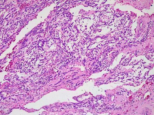 Figure 7 Histological features of ovarian yolk sac tumor. Mesenchyme-like pattern – tumor cells with variable atypia scattered in edematous and myxomatous connective tissue (HE x 10).