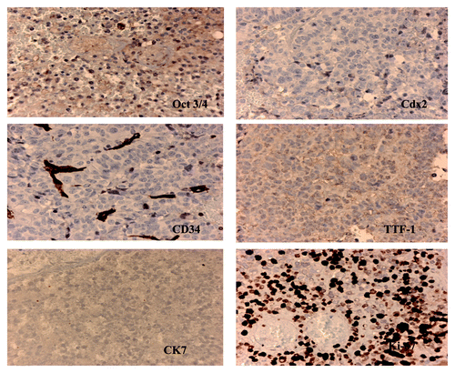 Figure 2. Immunohistochemical staining was done on the tumor tissue and it clearly shows that the tumor cells were negative for Cdx2, CD34 and were positive for Oct3/4. They were negative for TTF-1, CK7 and CD34.