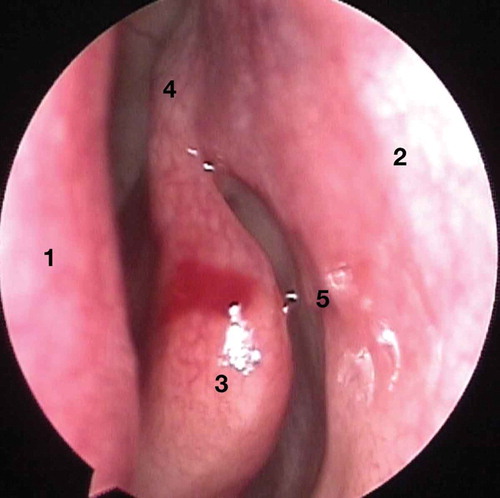 Figure 1. The endoscopic view of left nasal cavity. Some important landmarks are nasal septum (1), lateral nasal wall (2), middle turbinate (3), axilla of middle turbinate (4), and maxillary line (5).