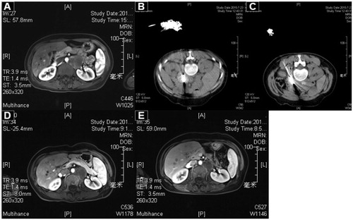 Figure 3. A 45-year-old female patient with poorly differentiated cervical squamous cell carcinoma and peritoneal metastasis was treated with MWA. (A) The enhanced CT pre-ablation. (B, C). The procedure of ablation (two antennae were applied). (D) Two months post-ablation. (E) Four months post-ablation.