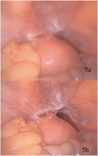 Figure 5. View of the pelvis prior to commencement of total laparoscopic hysterectomy with (a) initial fogging due to lens condensation and (b) Restoration of clarity following activation OpClear activation.