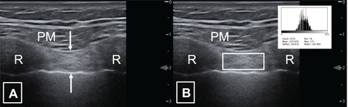 Figure 1 Parasternal intercostal muscle ultrasound.
