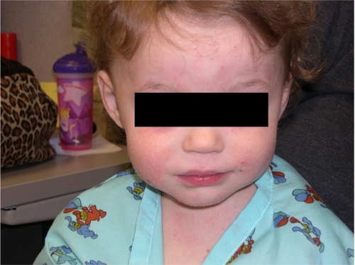 Figure 1 Atopic eczema affecting a young child’s face.