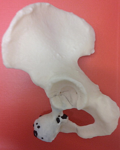 Figure 1. 3D model of the pelvis with chondrosarcoma.