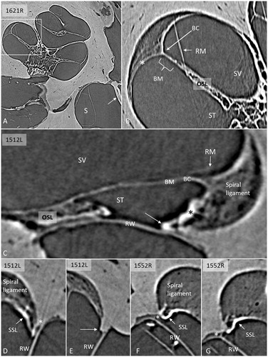 Figure 1. A: SR-PCI of a right human cochlea. Framed area is magnified in B. The saccule (S) and stapes plate (arrow) can be seen. B: Cochlear tissue is detectable, including Reissner’s membrane (RM), SL, and BM. C: SR-PCI of a left human ear at the level of the RW. The RM, BM, SL, and round window membrane (RWM) are clearly visible, as well as the limbus spirale. The SL facing the ST shows increased contrast (* and arrow). D–G: Sections showing the lateral attachment of the RW near the SL. There is some contrast enhancement of the ST wall facing the RW (arrows, SSL). There is often a space (*) between the RWM and the LW. (BC: basilar crest; BM: basilar membrane; LW: lateral wall; OC: otic capsule; OSL: osseous spiral lamina; RM: Reissner’s membrane; RW: round window; RWM: round window membrane; S: saccule; SL: spiral ligament; SR-PCI: synchrotron radiation phase contrast imaging; SSL: secondary spiral lamina; ST: scala tympani; SV: scala vestibuli).