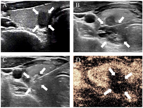 Figure 4. A 46-year-old woman with papillary thyroid cancer in the ‘danger triangle’ of the thyroid was treated with radiofrequency ablation (RFA).
