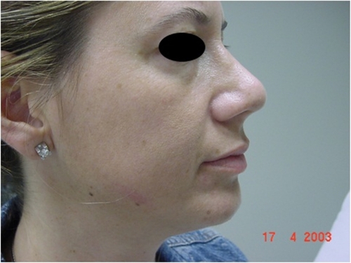Figure 4A Hyaluronic acid filler for facial sculpturing (midface) before injection.