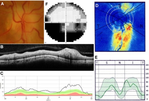 Figure 3 Representative case of nonarteritic anterior ischemic optic neuropathy.