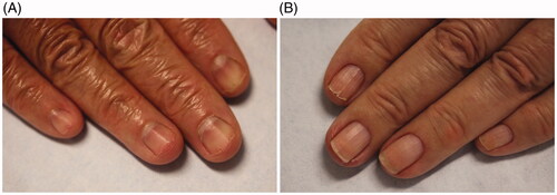 Figure 1. Clinical manifestations of brittle nail syndrome. (A) Lamellar onychoschizia. (B) Onychorrhexis.