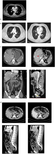 Figure 2. FCT scans of patients with suspected or confirmed VIPIT: The first scan (a) shows the pulmonary embolism in patient 1, the next two scans (b) shows the pulmonary embolism inpatient 3 and its diffuse pattern. The third scan series (c) show the mesenterial thrombosis in patient 4, and the last four scans (d) shows the mesenterial thrombosis and its extent in patient 5, with a positive anti PF4-test. They both show an extensive portal vein thrombosis (red arrow), best seen in (c) when comparing jugular and mesenterial vein contrast and best seen in d, in the sagittal view, when comparing arterial and venous phase. Both patients (c and d) show a extensive diffuse mesenteric thrombosis originating from the complete thrombosis of the splenic vein, indicating a possible immunologic origin with potential thrombotic chain reaction.