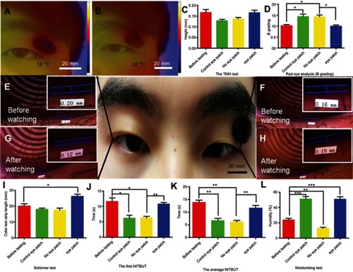 Figure 4 Customization of eye patches and evaluation of dry eye indicators. (A, B) The infrared heat distribution maps of the human with pasted eye patch before and after illumination. (C, D) TMH and red eye analysis (B Grading) of the human eye. (E, G) Photos of TMH of the groups without eye patches before and after watching the video for 3 hours. (F, H) Photos of TMH of the groups with eye patches before and after watching the same video. (I) The tear secretion test of human eyes was performed before or after watching a 3 hour video. (J) The first NITBUT test of human eyes was performed before or after watching a 3 hour video. (K) The average NITBUT test of human eyes was performed before or after watching a 3 hour video. (L) The eye patch moisturizing test was performed before or after watching a 3 hour video. Each group contained ten eyes. Error bars: SEM (unpaired t-test, *P<0.05, **P<0.01, ***P<0.001).Abbreviations: TMH, tear meniscus height; NITBUT, noninvasive tear breakup time.