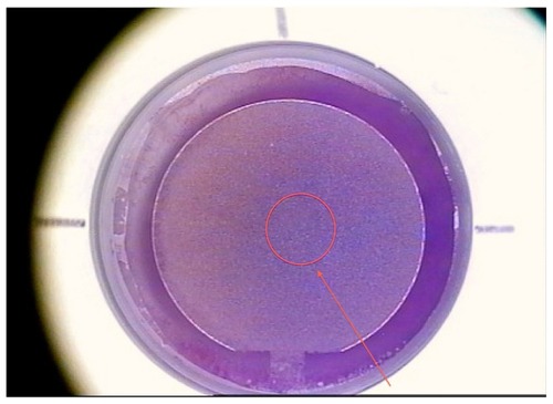 Figure 1 Flap-making report generated by the FS200 femtosecond laser.