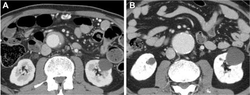 Figure 3 Aneurysm formation at the periaortic lesion of the abdominal aorta after glucocorticoid therapy. Before (A) and after (B) glucocorticoid therapy, the periaortic lesion is markedly ameliorated, while an aneurysm has developed at the same site.