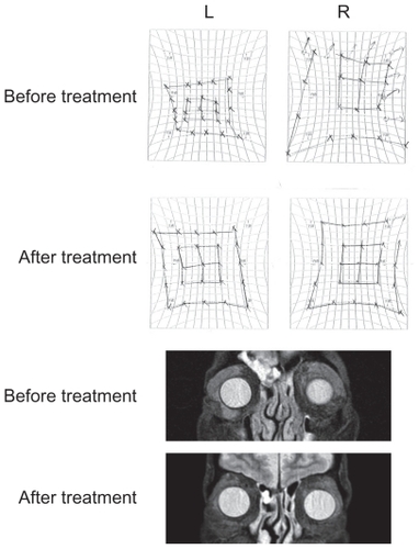 Figure 3 HESS charts and MRI findings before and after oral steroid administration. Both HESS charts and MRI findings were significantly improved after oral steroid administration. Six months after the treatment, no recurrence was observed. The effect of the oral steroid treatment was consistent with the histopathological findings of the specimen from the lacrimal glands.