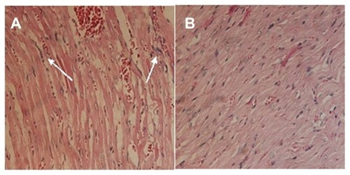 Figure 11 Histological photographs of mice cardiac muscles administrated with doxorubicin hydrochloride (A) and drug-loaded polyrotaxane nanoparticles (B).Note: The arrows show the inflammation.