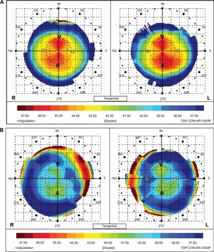 Figure 3 A) Color mapping without contact lens in a Group B patient. B) Color mapping of the same patient after soft toric lens fitting.