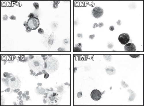 Figure 3 Immunocytochemistry for MMP-8 (A), MMP-9 (B), MMP-12 (C) and TIMP-1 (D) on the cytospins of induced sputum cells from a GOLD Stage 0 smokers. Clear immunoreactivity for each MMP was detectable in macrophages and neutrophils from all patient groups, especially from smokers and those at GOLD Stage 0.