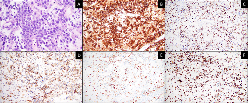 Figure 2 Pathologic Evaluation of the Left Parietal Tumor. H&E x40 magnification shows large B cells (A). IHC x20 magnification shows that the neoplastic B-cells stained positive for CD20 (B), BCL6 (C), BCL2 (D), MUM1 (E) with a high MIB1 proliferation rate (F).