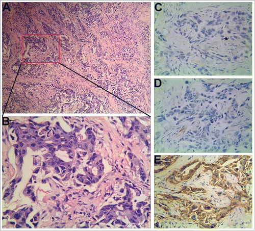 Figure 2. Histopathologic characteristics of the second primary BC of the patient. (A) Hematoxylin and eosin staining (× 100). (B) Hematoxylin and eosin staining (× 400). (C-E) Immunohistochemical staining (× 400). ER (−), PR1 (−), HER2 (2+).