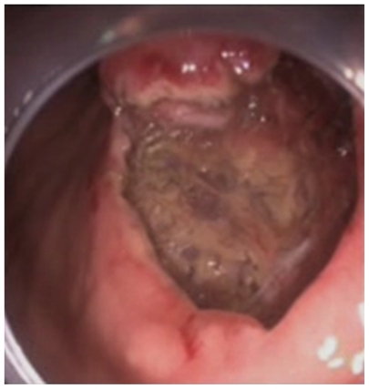 Figure 3 Aspect of the mucosal defect in the subcardial region before application of the endoclips.