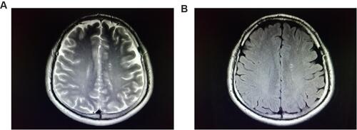 Figure 1 A 30-year-old female with a long point-like T2 signal (A) in the left parietal lobe and fluid-attenuated inversion recovery hyper signal (B), magnetic resonance imaging reported “white matter demyelinating degeneration” and a clinical diagnosis of “anxiety and depression.”.
