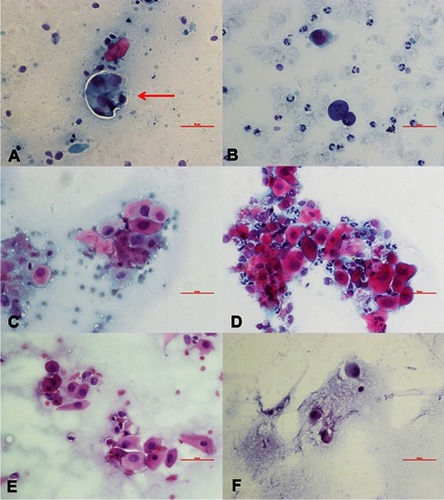 Figure 1 Exfoliative cytopathology of six OSSN cases stained using a Papanicolaou technique (×40). The cells are scattered under the microscope; enlarged cell and nuclear sizes, an increased karyoplasmic ratio, and an uneven distribution of thickened chromatin are observed, all of which suggest abnormal proliferation of the cancerous cells. Especially, in panel A, multiple heteromorphic cells aggregated into a structure similar to the “carcinoma nest” (red arrow). (A) Case 1. (B) Case 2. (C) Case 3. (D) Case 4. (E) Case 5. (F) Case 6. The plotting scale in each image is 50 µm (red bar).Abbreviation: OSSN, ocular surface squamous neoplasia.