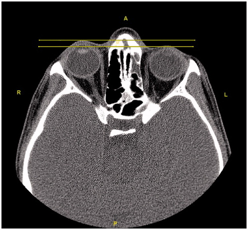 Figure 13. The axial section reveals that the left eyeball is located more posteriorly than the right one.