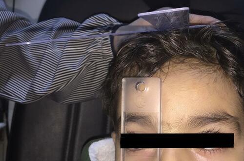 Figure 1 Measurement of right gaze deviation at 30 degree using hand-held orthopedic goniometer.