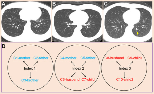 Figure 1 Chest computed tomography performance of the indexes and contact tracing investigation of their contacts. (A and B) completely normal computed tomography of Case 1 and Case 2; (C) a slight single subpleural patch on the left side of Case 3 (yellow arrow); (D) contact tracing investigation of three clusters. The blue color indicates contacts living with indexes in the same apartment, eating together but sleeping in different rooms; the red color indicates persons with the closest contact with the indexes—living in the same apartment, eating together, and sleeping in the same rooms. None of the contacts were infected, according to their symptoms and the nucleic acid and serologic tests.