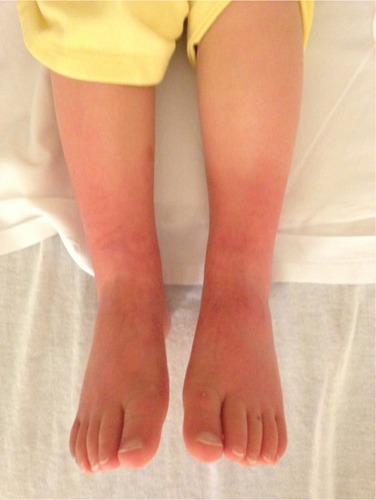 Figure 3 Photograph of the lower extremities of patient 1 demonstrating decreased erythema and discoloration immediately after the CT-guided LSB.