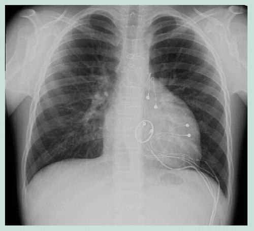 Figure 3. Chest x-ray in a patient with congenital heart disease and epicardial cardiac resynchronization therapy.A postero–anterior chest x-ray is shown in a patient with congenital heart disease, a mechanical mitral valve and epicardial cardiac resynchronization therapy. Note the presence and configuration of the three bipolar epicardial leads, positioned on the right atrial surface, at the level of the basal to mid-right ventricular free-wall segments, and on the left ventricular lateral free wall. Bipoles were placed 1 cm apart.Reproduced with permission from Citation[11].