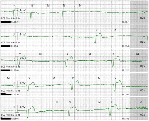 Figure 2. Telemetry showing 9–10 seconds of ventricular standstill with frequent EBVs.