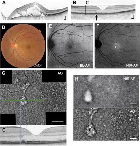 Figure 1 Left eye of a 33-year-old man with Vogt-Koyanagi-Harada disease (case 1). (A) Horizontal spectral-domain optical coherence tomography (SD-OCT) image of the fovea before steroid treatment. bar =200 μm. (B, C) SD-OCT image at 4 weeks after steroid treatment when the serous retinal detachment was resolved. Elevation of the RPE layer was observed (arrows). bar =200 μm. Color fundus photograph (D), blue-light fundus autofluorescence (BL-AF) (E), near-infrared fundus autofluorescence (NIR-AF) (F) images of the fundus at the time the serous retinal detachment resolved. In NIR-AF image, hyper autofluorescence in the macula. (G) The AO panorama image of fovea (bar =500 μm). Hyper-reflective lesions were observed at the nasal side of the fovea, and that lesion is corresponding to the elevation of the RPE layer in the OCT. Enlarged images of NIR-AF (H) and AO image (I) of the fovea (image size 2.2×1.1 mm). In the AO image, the boundary of the lesion was clearer. bar =200 μm.Abbreviations: RPE, retinal pigment epithelium; AO, adaptive optics.