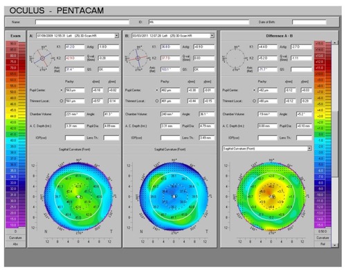 Figure 1 Pentacam (Oculus Inc, Wetzlar, Germany) axial curvature difference map comparing pre- and postoperative curvature to assess treatment centration.