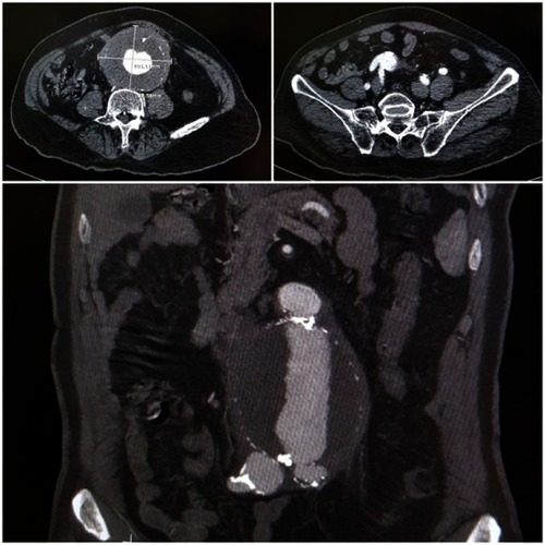 Figure 2 Preoperative CTA: (A) axial view showing a thick-walled 10 cm infrarenal AAA, Magnification x1(B and C) Axial (Magnification X1) and coronal (Magnification X2) views showing an aneurysmal extension into to right IIA.