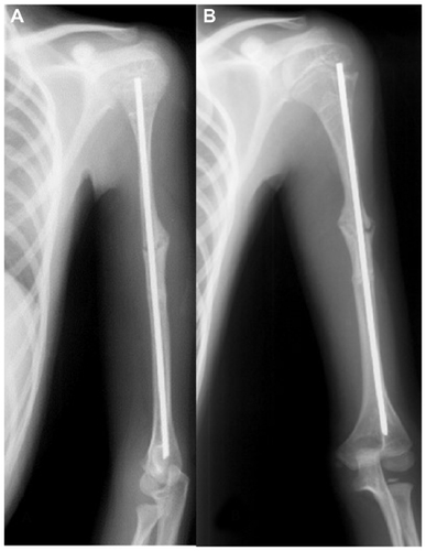 Figure 4 Male, 18-years-old, OI type III.