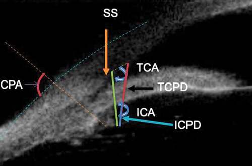 Figure 6. Figure depicting scleral ciliary process angle (SCPA), Trabecular ciliary angle (TCA), Iris ciliary angle (ICA), Trabecular ciliary process distance (TCPD) and Iris ciliary process distance (ICPD). SS: scleral spur.