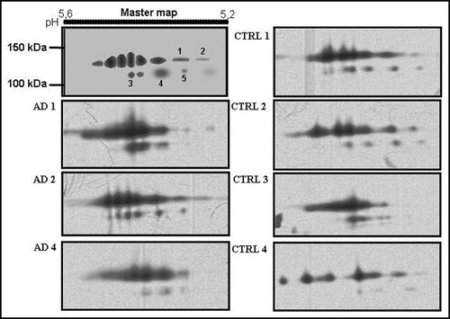 Figure 1 2D quantitative analysis of serum ceruloplasmin isoforms at 135 and 115 kDa. A master map was created utilizing PDQuest software from a triplicate of AD sample and a quadruplicate of control sample. The optical density analysis of the spots did not show statistically significant differences between AD and control samples.