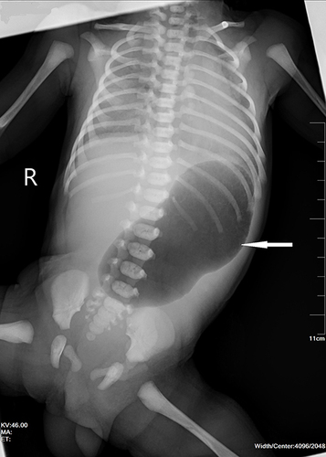 Figure 6 Abdominal X-ray reveals a single gas bubble in a distended stomach with no gas detected in the distal portions, indicating pyloric atresia (PA).