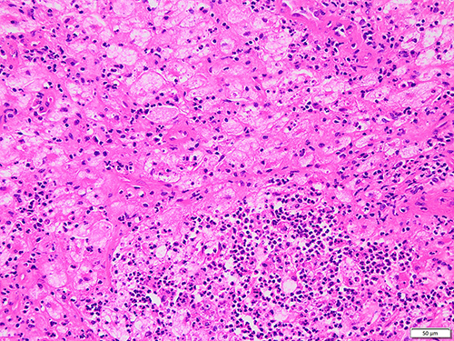 Figure 5 The features of bright and dark areas were not obvious with extensive neutrophil infiltration (HE).