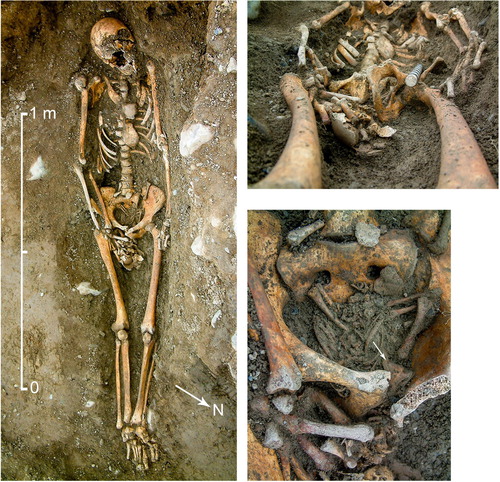 Figure 4. The head of C 957, of 38–40 weeks gestation, from Ballykilmore 6, Co. Westmeath, extruded through the mother’s (C 955) pelvic inlet. It seems feasible that death had occurred when the fetus had been partially delivered and that labour may have been obstructed due to shoulder dystocia (photographs courtesy of John Channing).